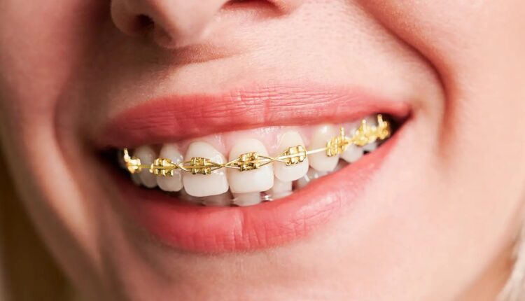 Gold Braces