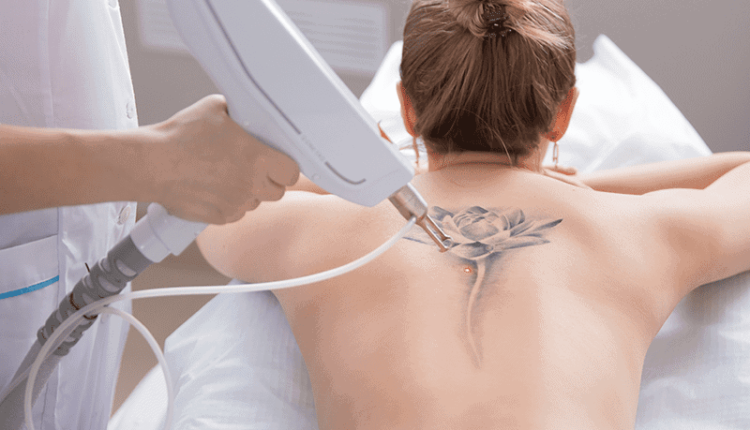 Tattoo Removal 3